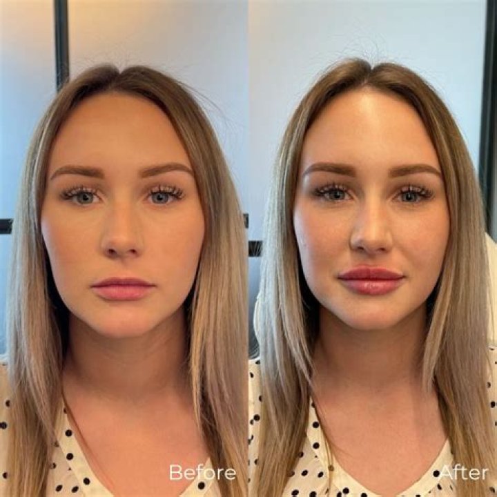 Brielle Biermann Reveals Why She Got Lip Filler Again After Removing Them ‘Completely’ — Watch