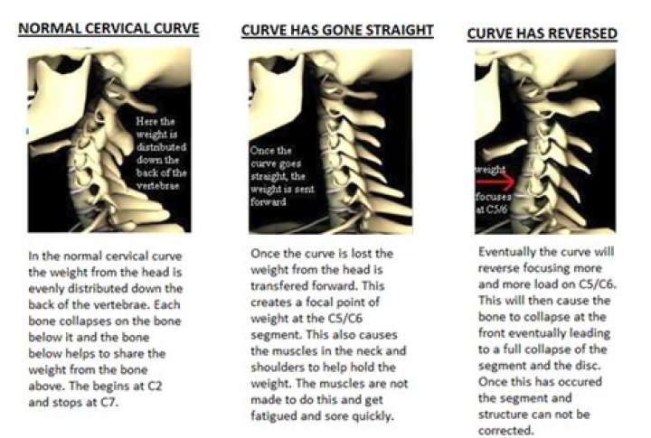 Can a reverse cervical curve be corrected?