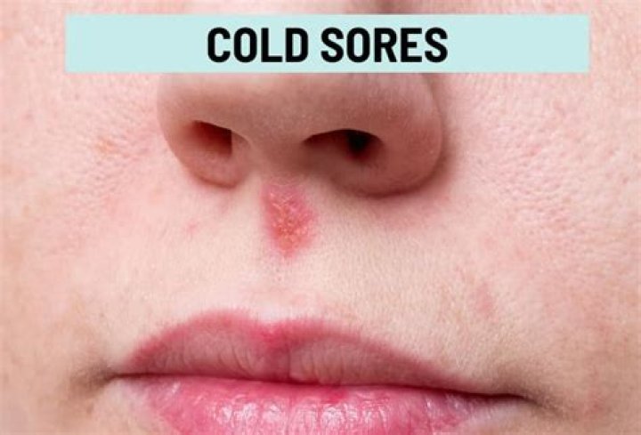 Can you get cold sores around your nose?
