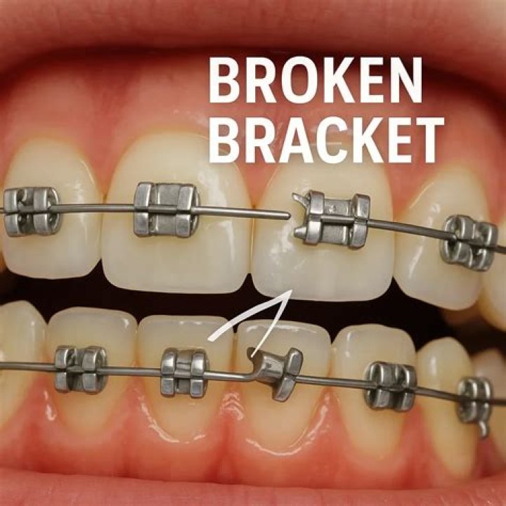 Do braces still work with a broken bracket?