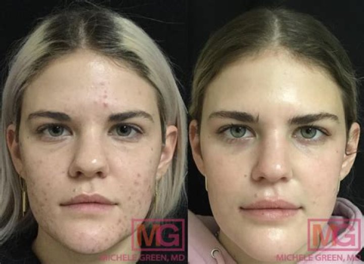 Does scarring go away after Accutane?