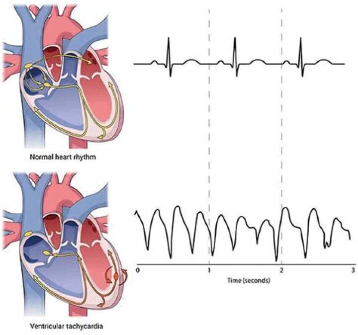 Does tachypnea cause tachycardia?