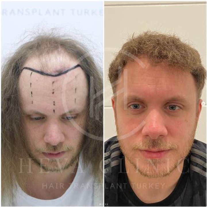 Glimpse Of Joey Logano Hair Transplant Before and After