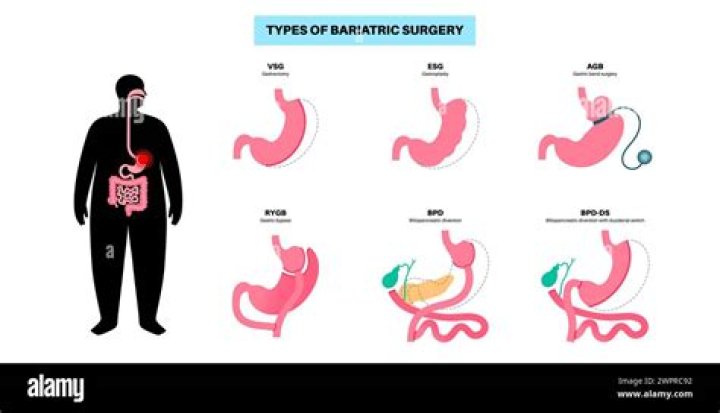 How can I get bariatric surgery for free?