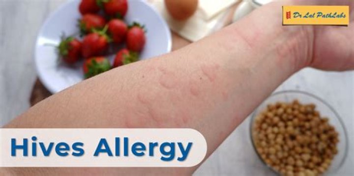 How can I help someone with hives?