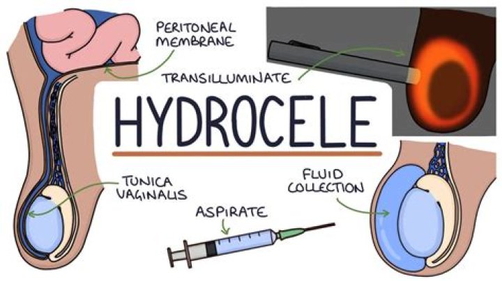 How common are Spermatoceles?