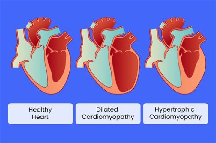 How do you assess for hypertrophic obstructive cardiomyopathy?