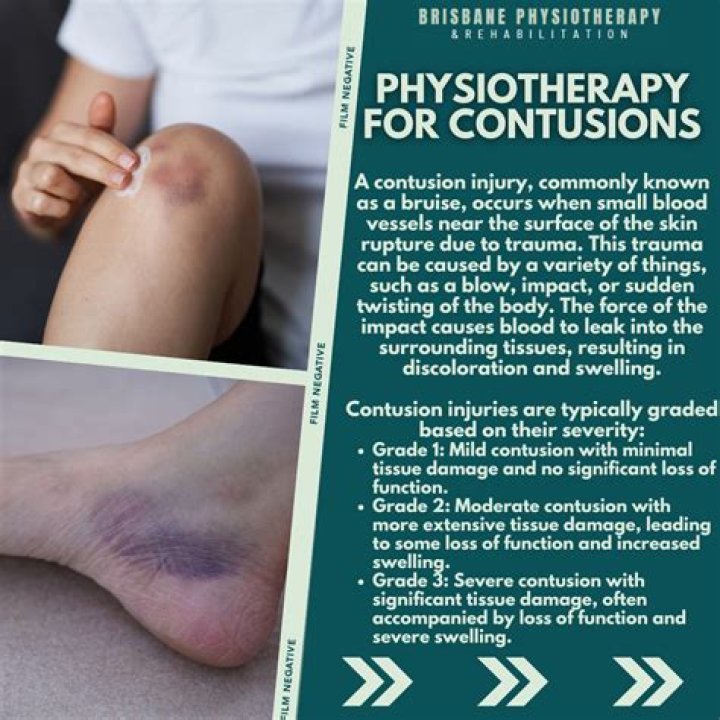 How do you treat a leg contusion?