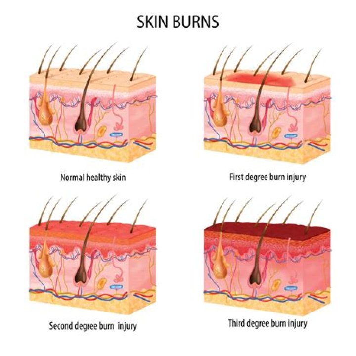 How do you treat a partial thickness burn?