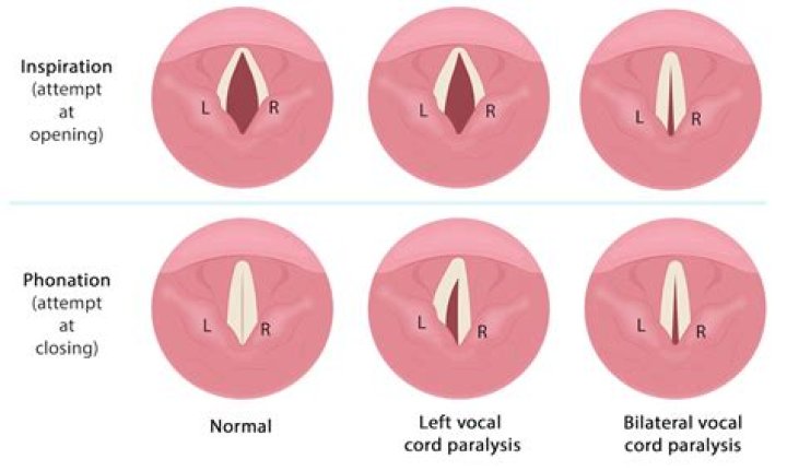 How do you treat laryngeal spasms?