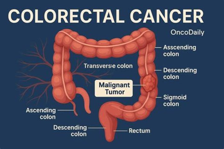 How does right sided colon cancer present?