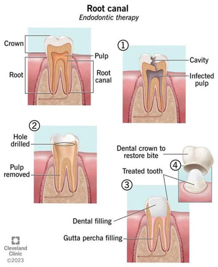 How long after a root canal should I get a crown?