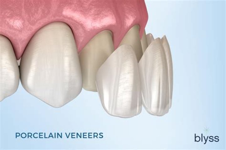 How much do porcelain veneers cost in Mexico?