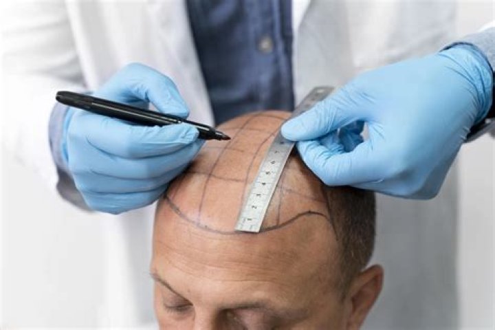 How much does the average hair restoration cost?