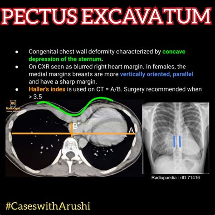 Is it bad to have pectus excavatum?