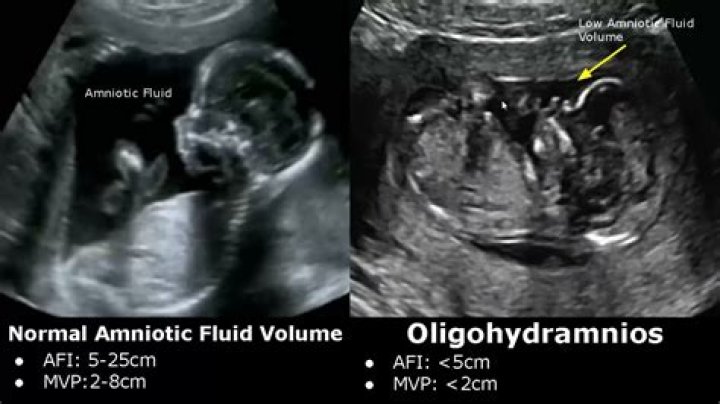 Is oligohydramnios genetic?