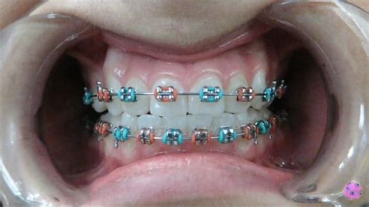 Is orange a good color for braces?