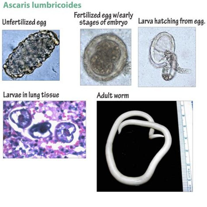 What are the symptoms of toxocariasis?