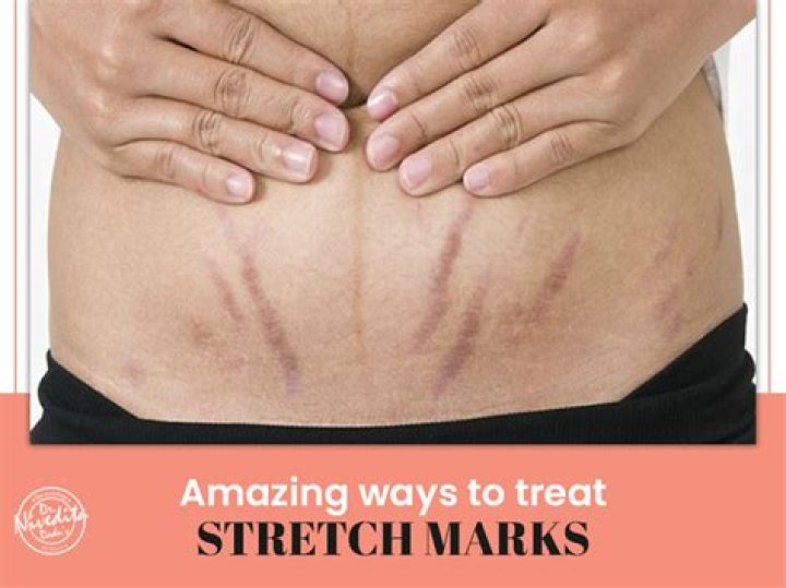 What do stomach stretch marks look like?