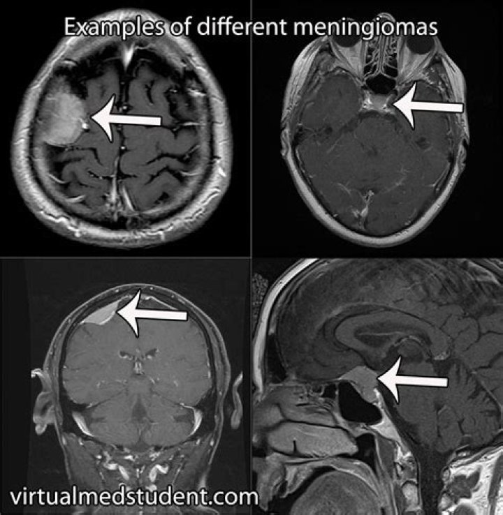 What does a meningioma look like on MRI?