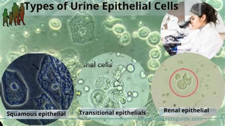 What does it mean if you have squamous epithelial cells in your urine?