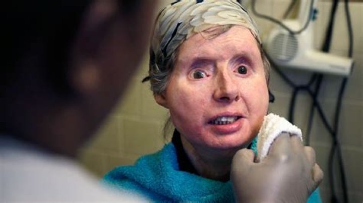 What Happened To Charla Nash? Woman Had To Undergo Face Transplant Surgery After Chimp Attack