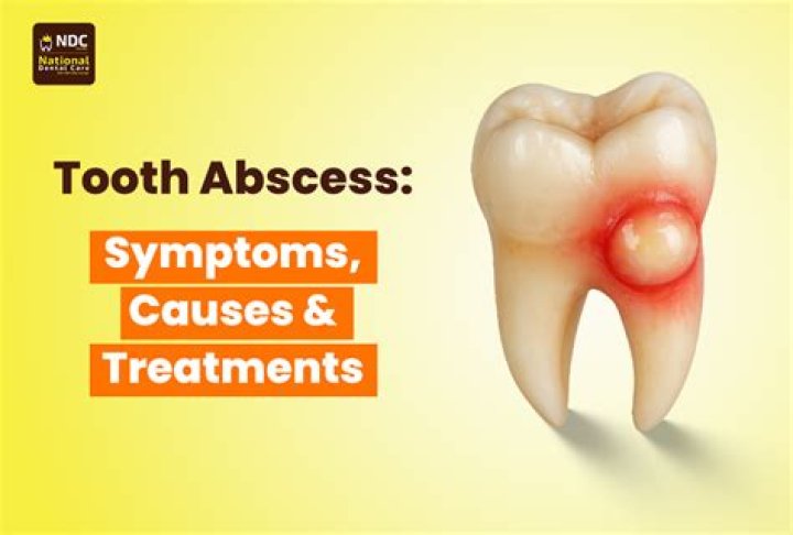 What happens if an abscess tooth pops in your mouth?