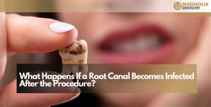 What happens if root canal is left open?