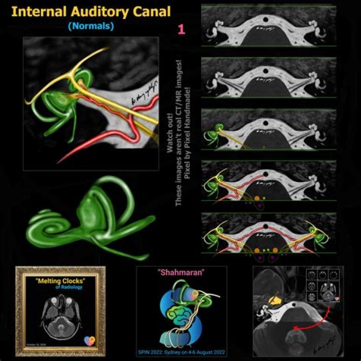 What is an MRI of the internal auditory canals?