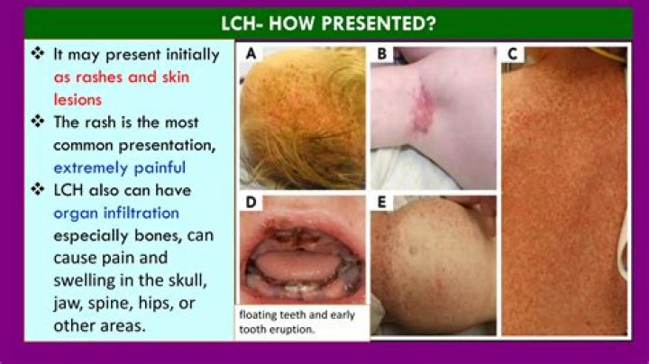 What is CME and LCH?