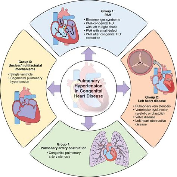 What is hypertensive heart disease without CHF?