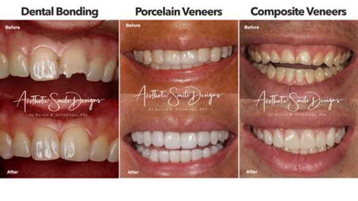 What is the downside to veneers?
