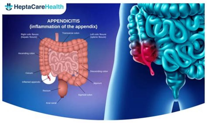 Which doctor is best for appendicitis?