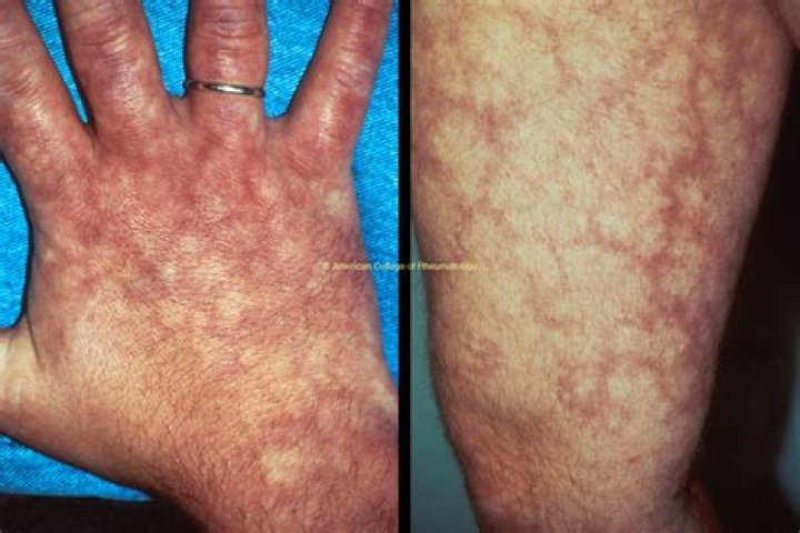 Why does livedo reticularis happen?